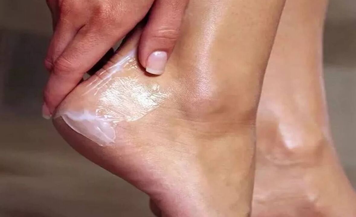 Come trattare il fungo del piede con crema divertente