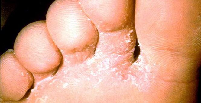 Lesione del fungo della pelle tra le dita dei piedi