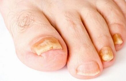 ingiallimento delle unghie dei piedi a causa di funghi