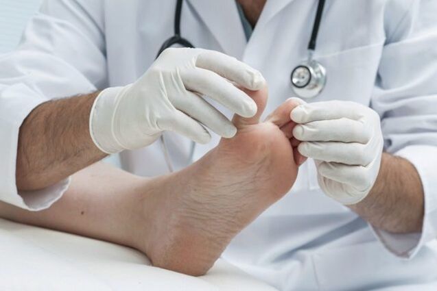 diagnosi di fungo del piede da parte di un medico